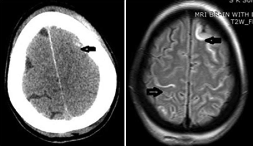 Moderate and Severe Traumatic Brain Injury