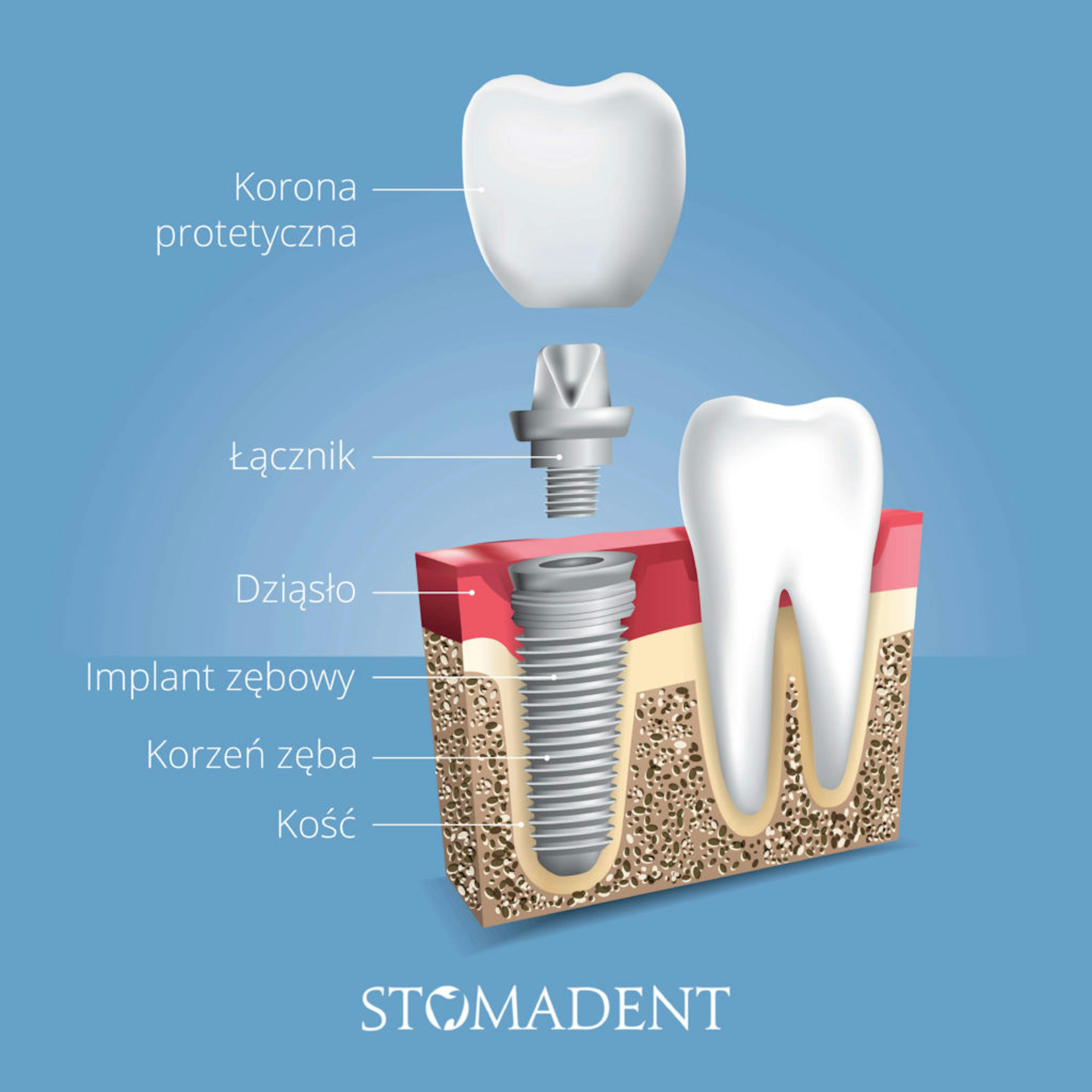 Stomadent Implant