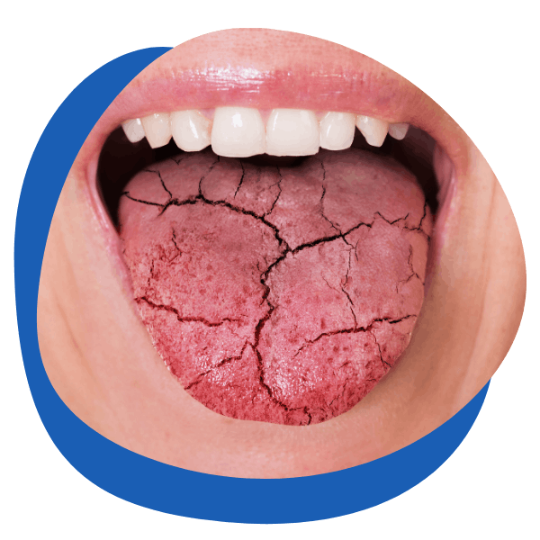 a tongue stuck out to show a dry mouth and cracked tongue round picture icon for dry mouth treatment categories from My Private Pharmacist Online pharmacy 