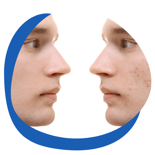 Acne solutions – Before and after comparison of a person’s face showing clear and blemished skin. Suitable for acne treatments, skincare products, and spot removal solutions.