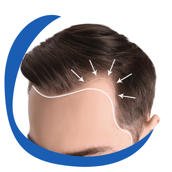 male pattern baldness areas where hair starts receding - round icon for Men's hair retention treatment category from My Private Pharmacist Online pharmacy