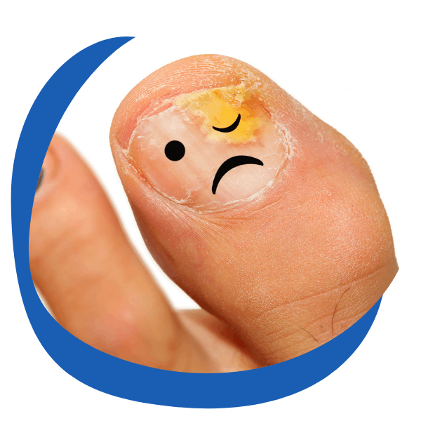 big toe with a drawing of a face on it looking unhappy- round icon image for fungal nail treatment categories from My Private Pharmacist Online pharmacy
