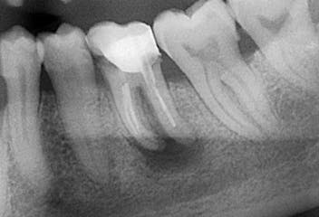 cisti dentale
