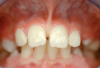 diastema