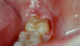 pericoronite