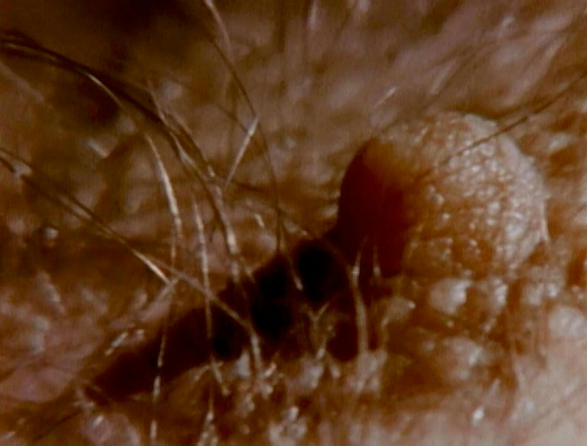 Close-up of a skin surface with a cluster of small, dark, round bumps and a few thin strands of hair. The texture of the skin appears rough and uneven.