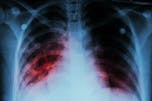 Tuberculosis en pulmones