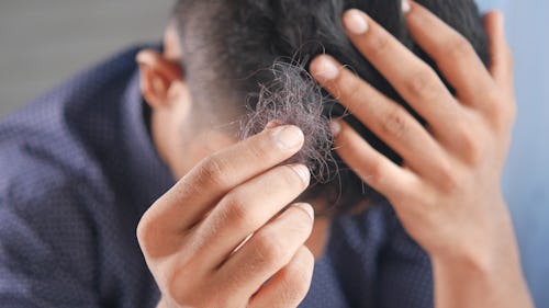 A man with hairs falling off from his head (alopecia)