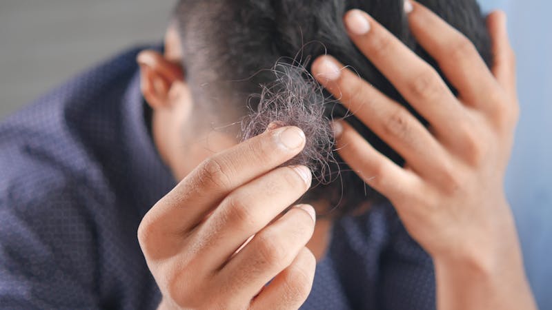 A man with hairs falling off from his head (alopecia)