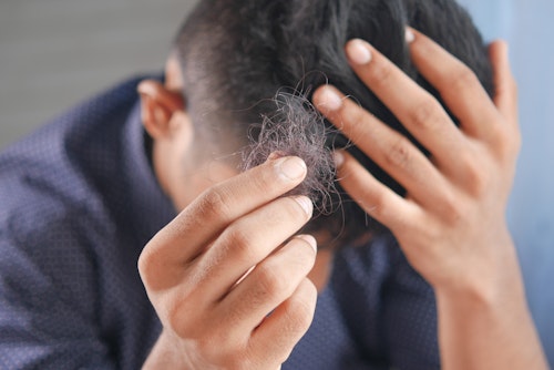 A man with hairs falling off from his head (alopecia)