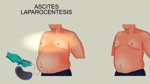 Avatar illustration of ascite laparocentesis