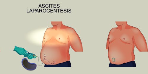 Avatar illustration of ascite laparocentesis