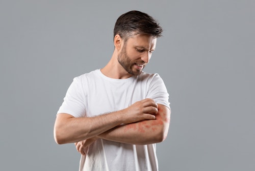 A man with itchy spongiotic dermatitis scratching his skin