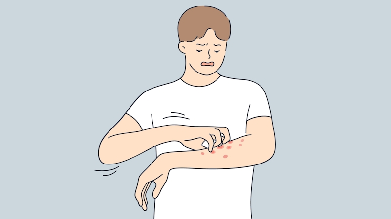Image illustration of a man with a skin rash