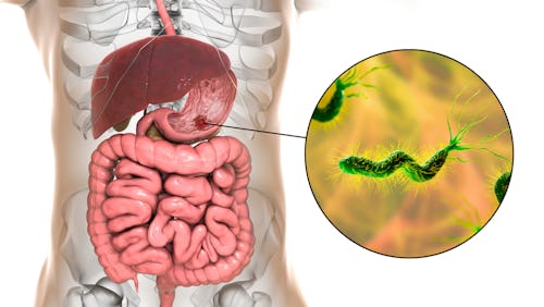 stomach mucosa infected by Helicobacter pylori bacteria causing sores and ulcer