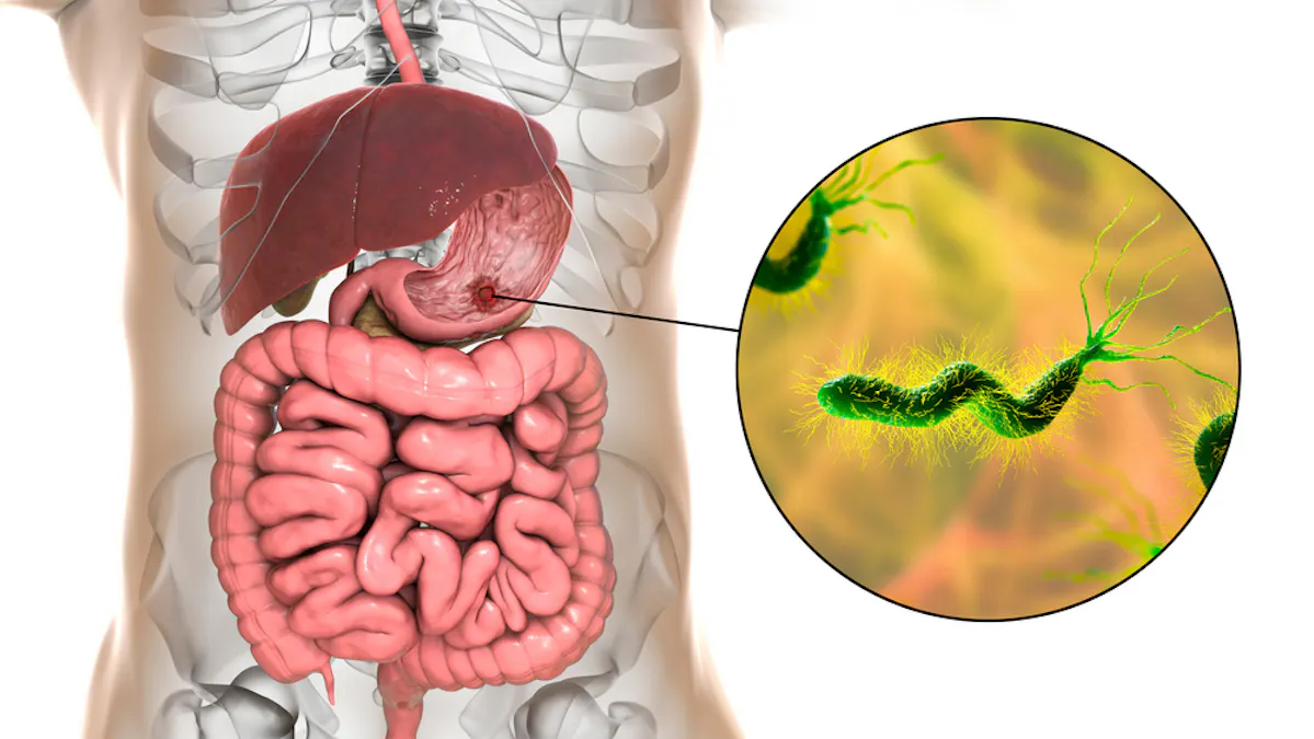 What Is Stomach Ulcer