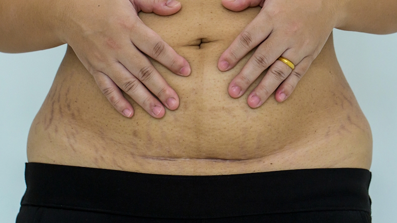 A woman with protruding belly, increased belly fat and hysterectomy scar