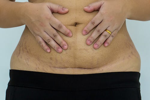 A woman with protruding belly, increased belly fat and hysterectomy scar