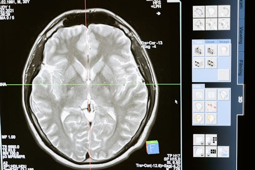 A brain CT scan showing a cross-section of the brain with a benign brain tumor