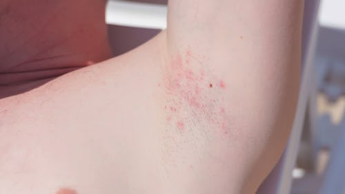 Rashes in the armpit caused by herpes simplex virus