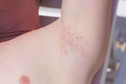 Rashes in the armpit caused by herpes simplex virus