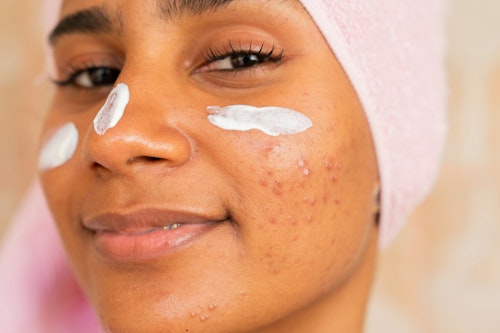 Image of a Black woman with pimples and acne on her face applying a facial cream