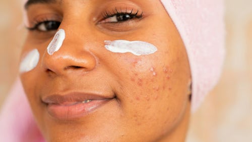 Image of a Black woman with pimples and acne on her face applying a facial cream