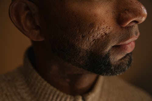 Black man with acne scars on his chin