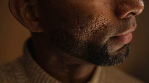 Black man with acne scars on his chin