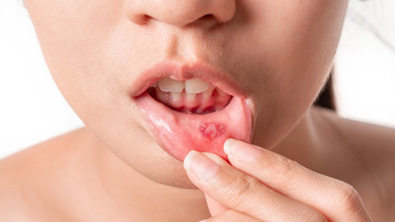 A woman with mouth ulcer showing the sore on her lips
