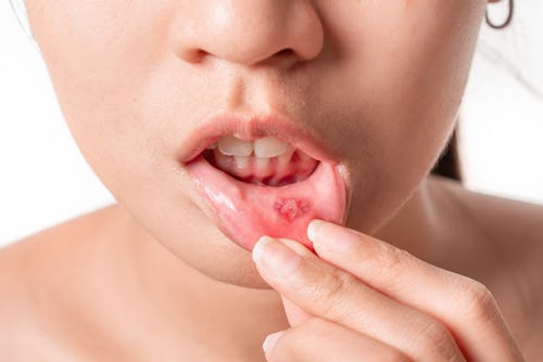 A woman with mouth ulcer showing the sore on her lips