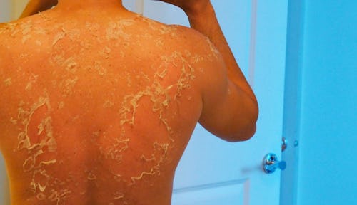 A woman with lamellar ichthyosis (skin shedding)