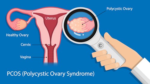 polycystic ovarian syndrome (PCOS)