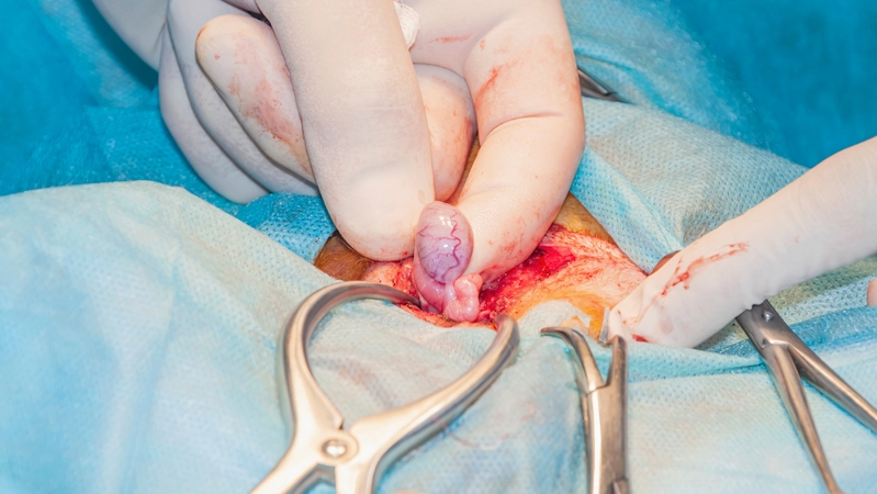 Penile surgery (penectomy)