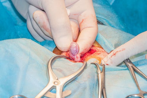 Penile surgery (penectomy)