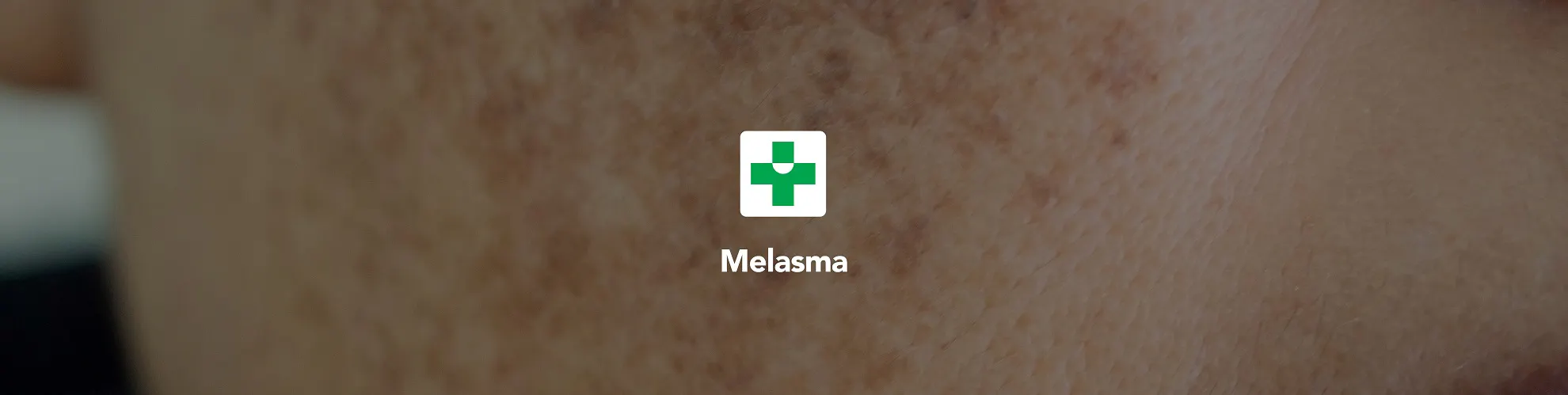 Melasma