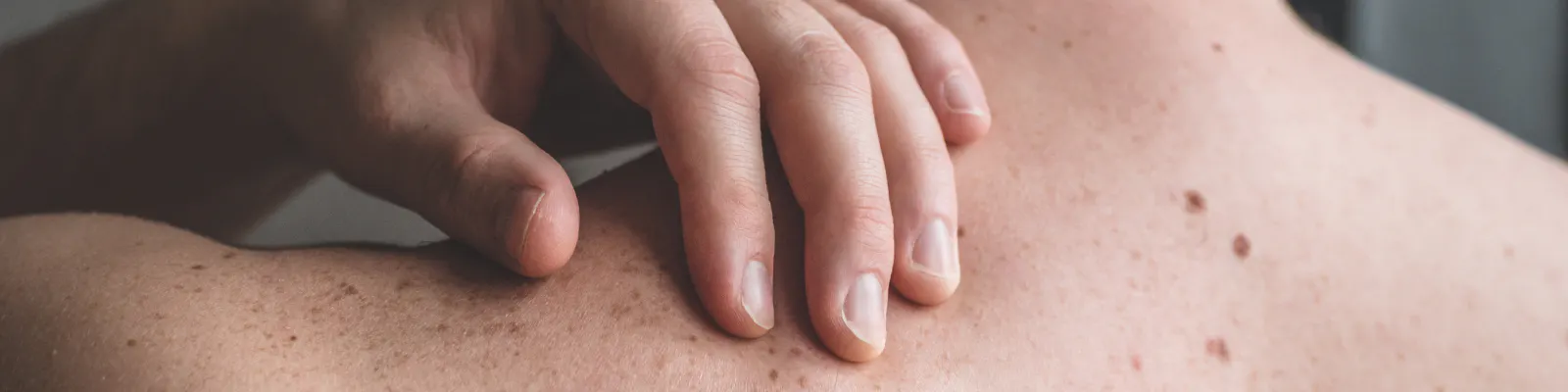 What is it like to experience melanoma?