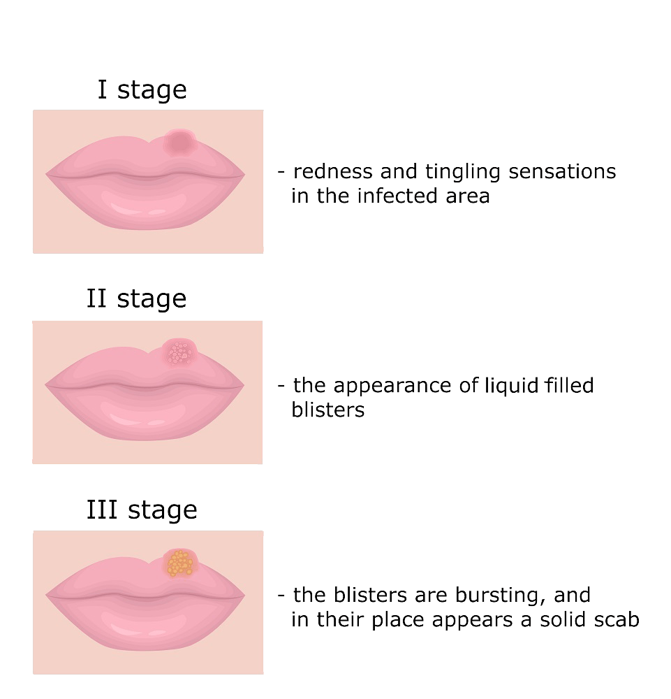 cold-sore-on-lower-lip