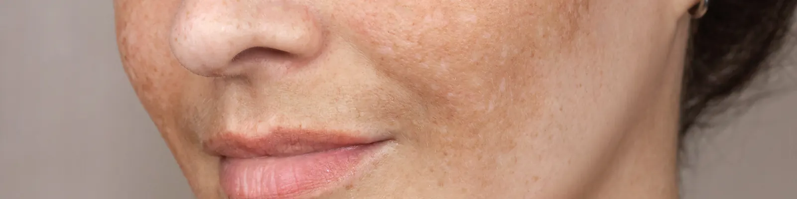 Want tips for hyperpigmentation and age spots? Read on