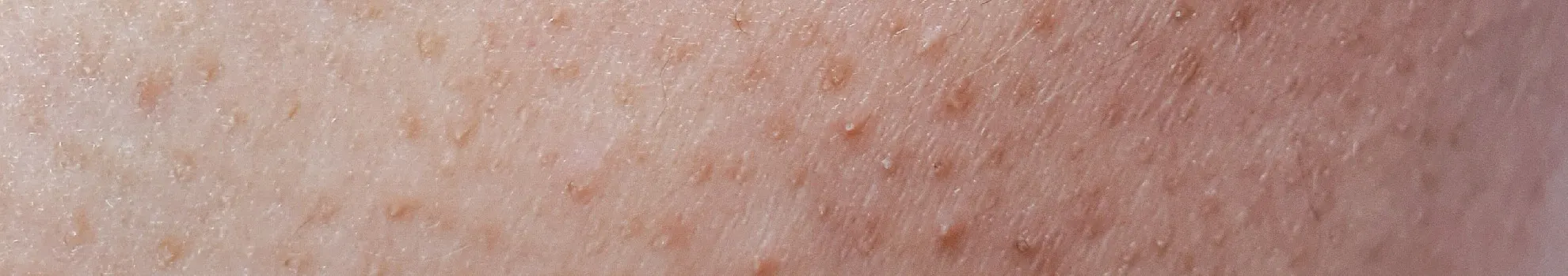 Keratosis Pilaris (Chicken Skin)