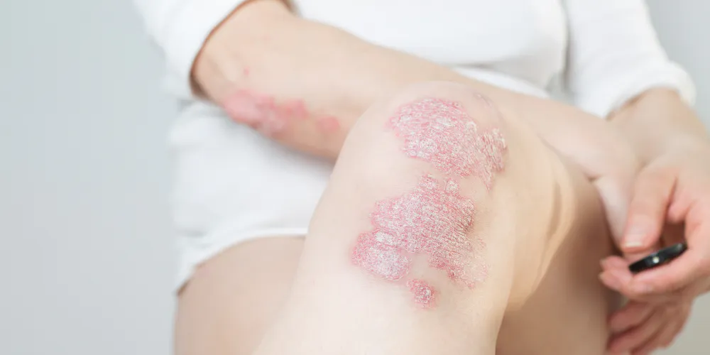 All about psoriasis: 10 questions, answered