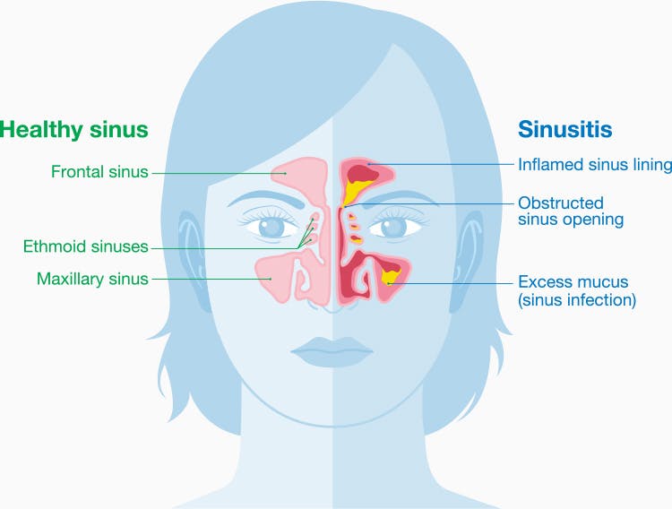 swollen sinus medicine