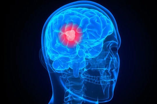 Oligodendroglioma Education Day Webinar