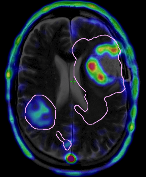 The Brain Cancer Group