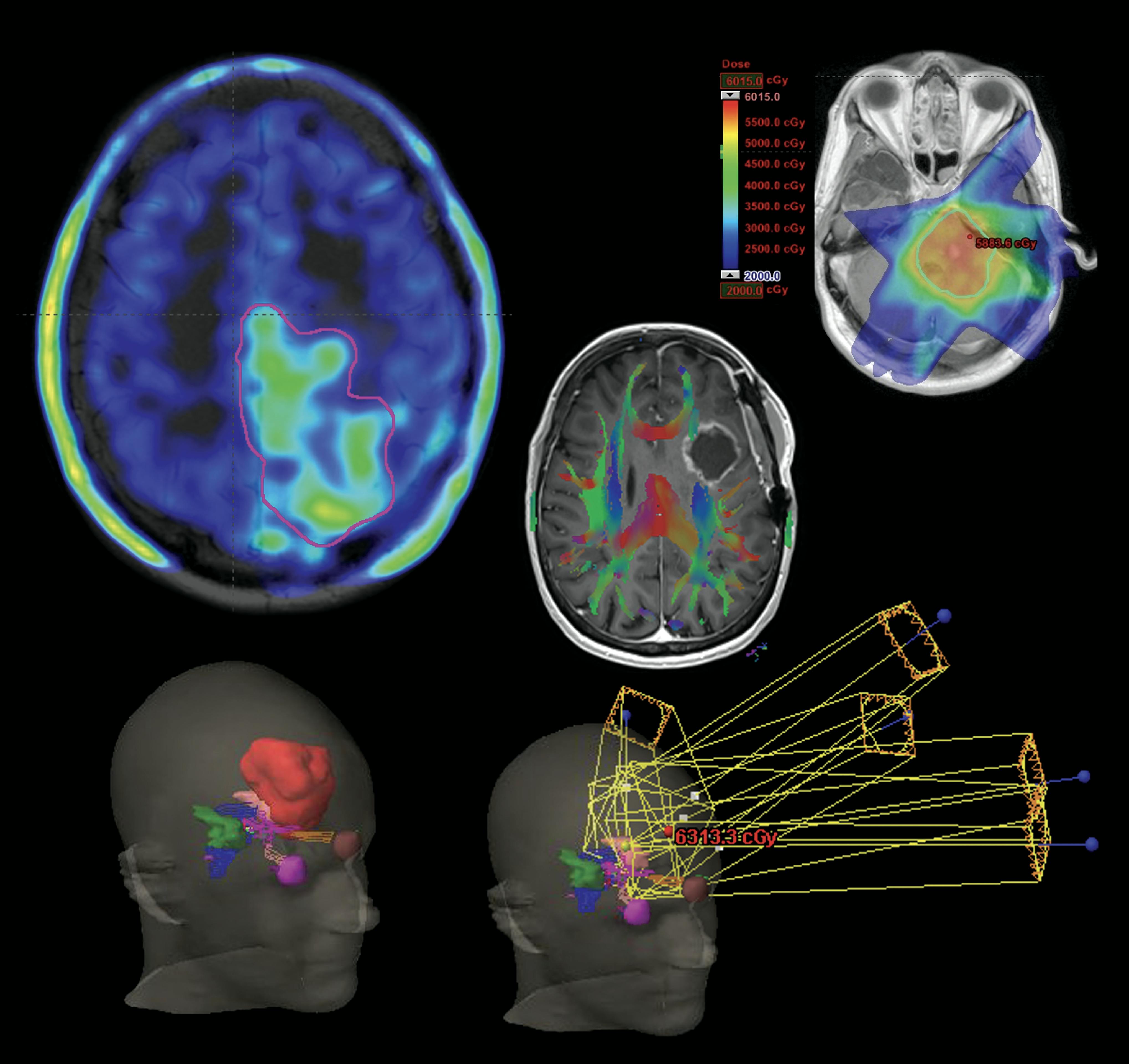 The Brain Cancer Group