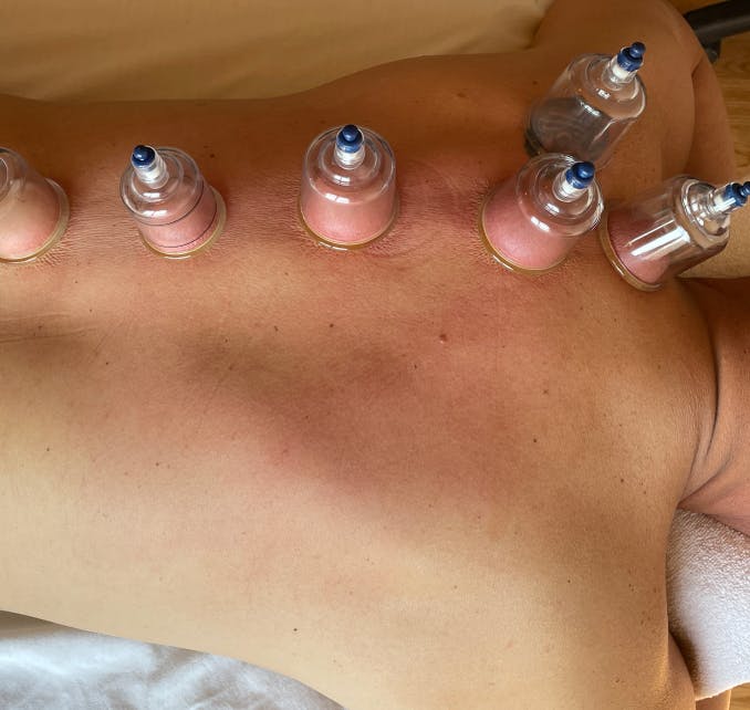 Cups placed along spine of a male's back