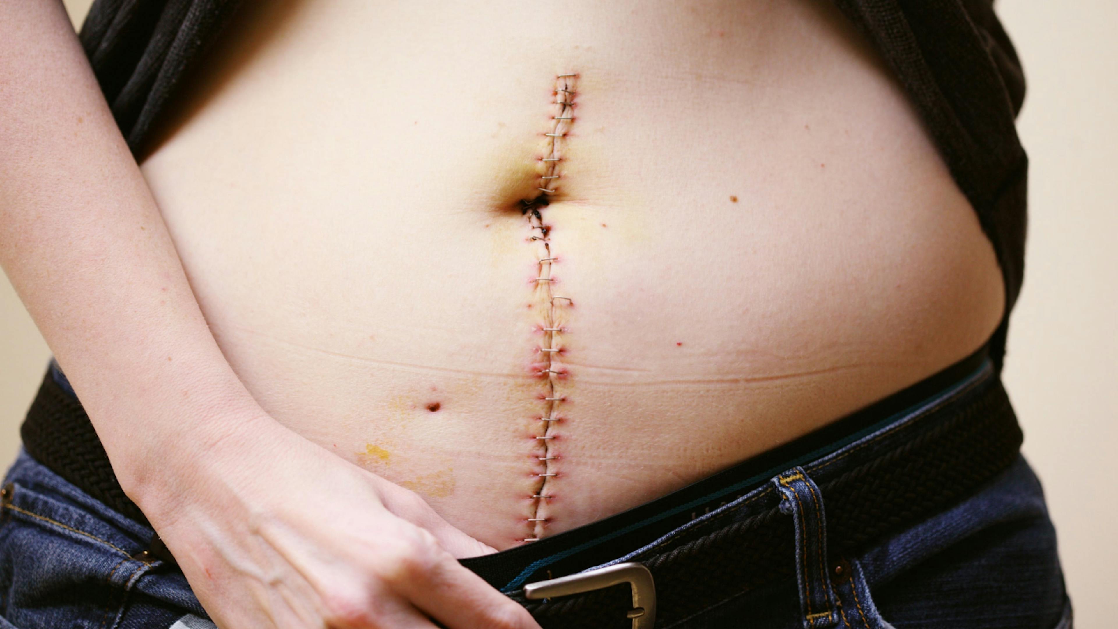 A surgical wound from an ovarian fibroma surgery.
