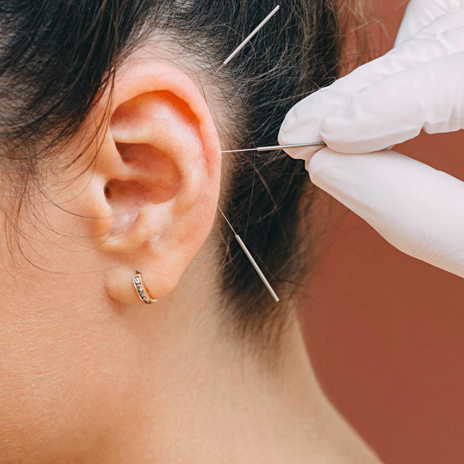 Acupuncture