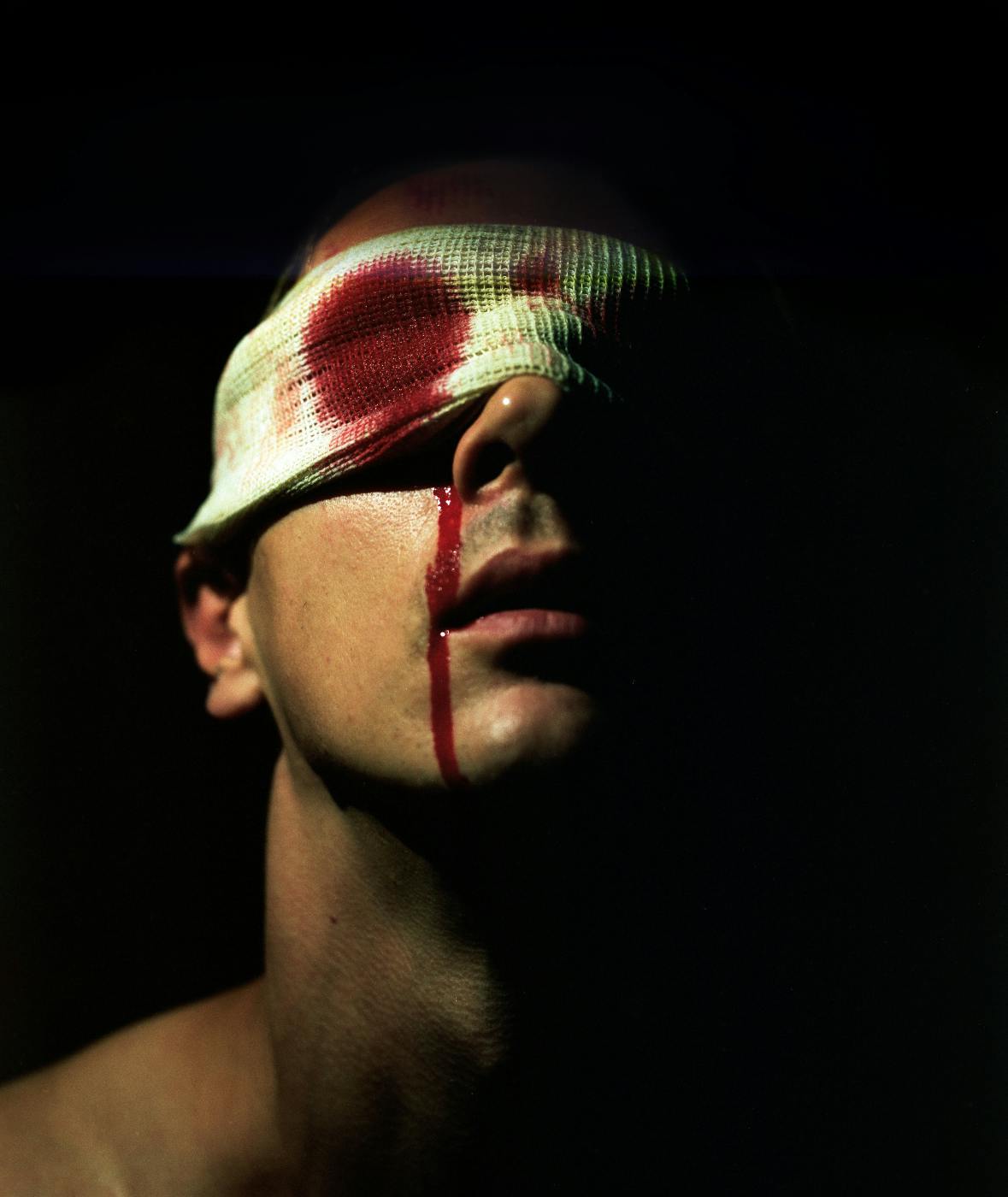 a man with a bloody face and gauze over his eyes