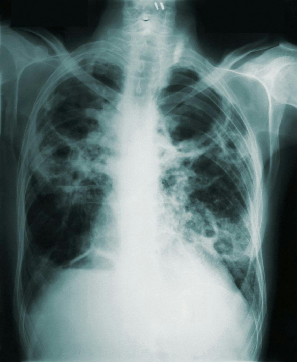An e-ray of a person's chest